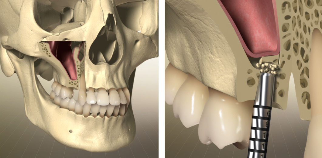 3D-Animation | Erklärfilme für die Implantologie