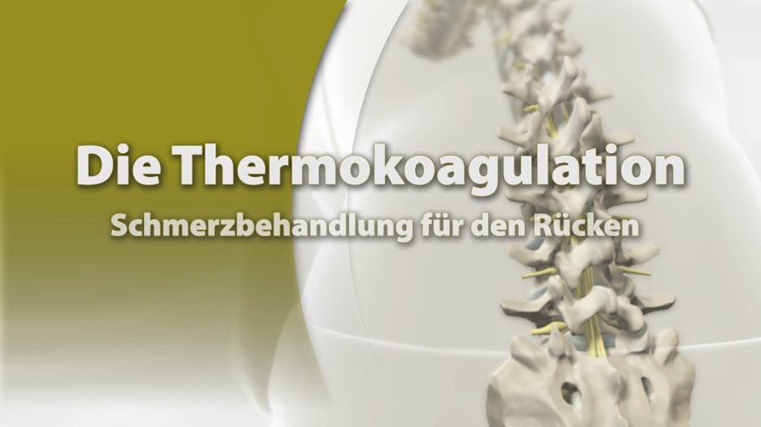 Erklärfilm für Patienten | 003 Thermokoagulation